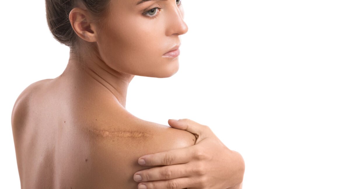 Terapia neural para cicatrices